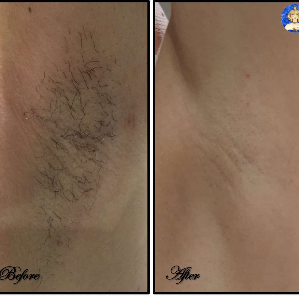 arm laser before and after