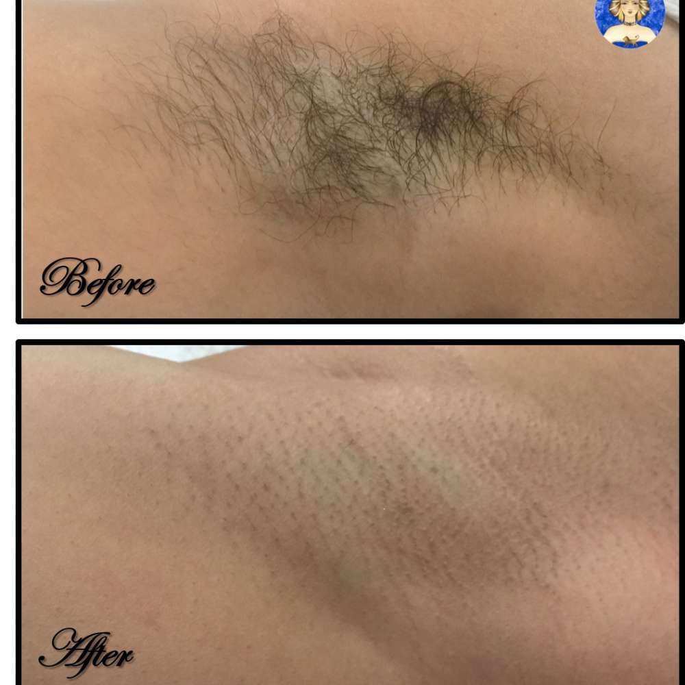 arm laser before and after